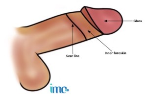 Style de circoncision normal avec la ligne de cicatrice à un endroit intermédiaire. L'étanchéité est intermédiaire.