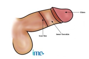 Style de circoncision élevé et serré avec un style de circoncision élevé, plus éloigné de la glande et plus proche du scrotum. La peau est tendue mais confortable.